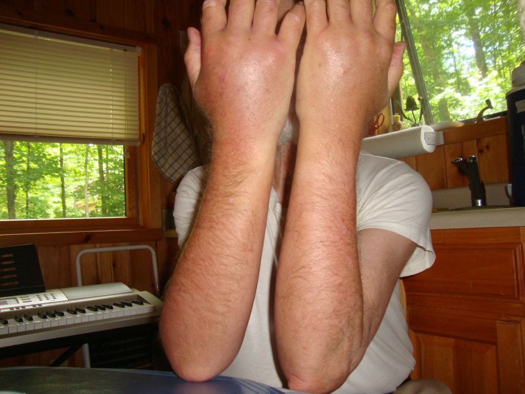 Right hand hornets!
Rangers' signs warned of hornet and wasp activity. Besides my July 14 stings on June 23 I was also stung 3 times. (Jeff Cohen, of Lot 22, was stung 8 times at the river register. I'd be dead, I think.) I arose several times at night to ice the itching right forearm. It was back to normal in a few days.